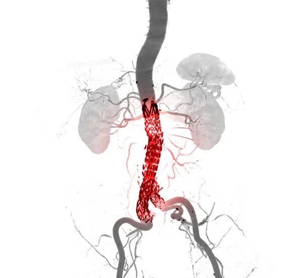 腹主动脉瘤的Cta全主动脉与腹主动脉支架移植术的三维图像比较 — 图库照片