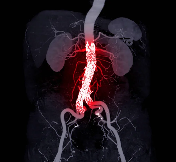 Aneurismas Aorta Abdominal Com Endoprótese Aorta Abdominal Comparam Imagem Renderização — Fotografia de Stock