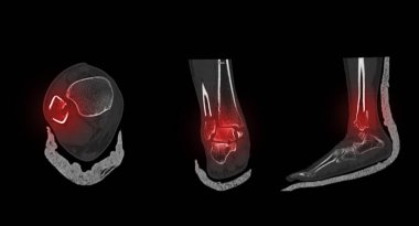 Ayak bileği ve ayak tomografisi ya da ayak bileği eklemi ve ayak 3Doyan resim kırık kaval kemiği ve kamış kemiği gösteriyor.
