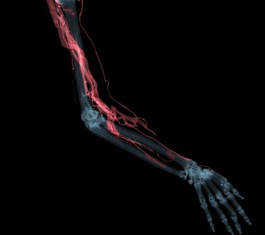 Kolun üst ekstremite arterleri tomografide 3D kemiğe sahip..