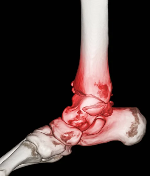 Ctスキャン足首や足や足首の関節や足のコンピュータ断層撮影骨折ティビアとフィブラ骨を示す3Dレンダリング画像 — ストック写真
