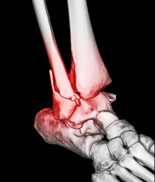 Ctスキャン足首や足や足首の関節や足のコンピュータ断層撮影骨折ティビアとフィブラ骨を示す3Dレンダリング画像 — ストック写真