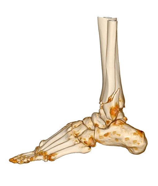 足部Ct扫描或脚踝关节 足部三维Ct显像显示胫骨 腓骨骨折 — 图库照片