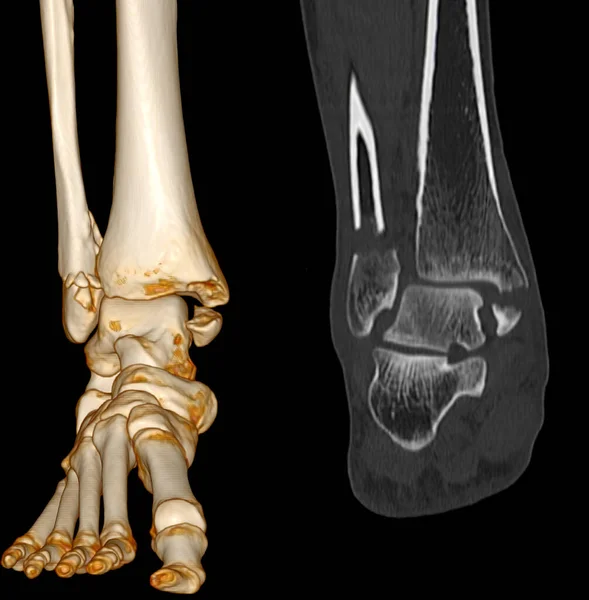Scan Ankle Foot Computed Tomography Ankle Joint Foot 3Drender Image — стокове фото