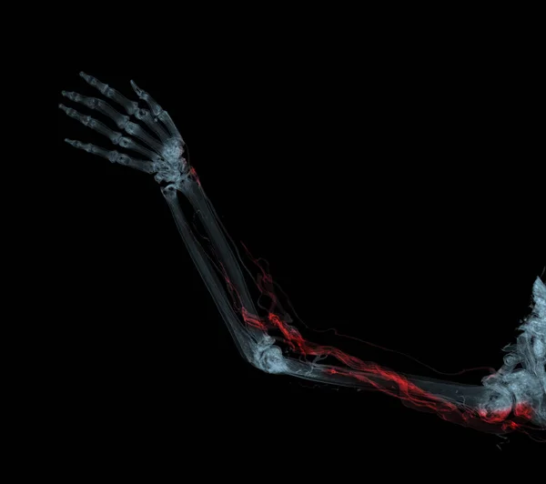 Tętnice Ramienne Ramienia Kończyn Górnych Bone Renderowania Tomografii Komputerowej — Zdjęcie stockowe