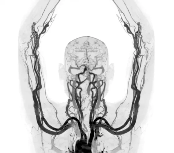 Ctスキャナからの上肢骨3Dレンダリングで腕の勇敢な動脈 — ストック写真