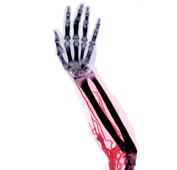 Ct扫描上肢骨三维重建臂腕关节的研究 — 图库照片