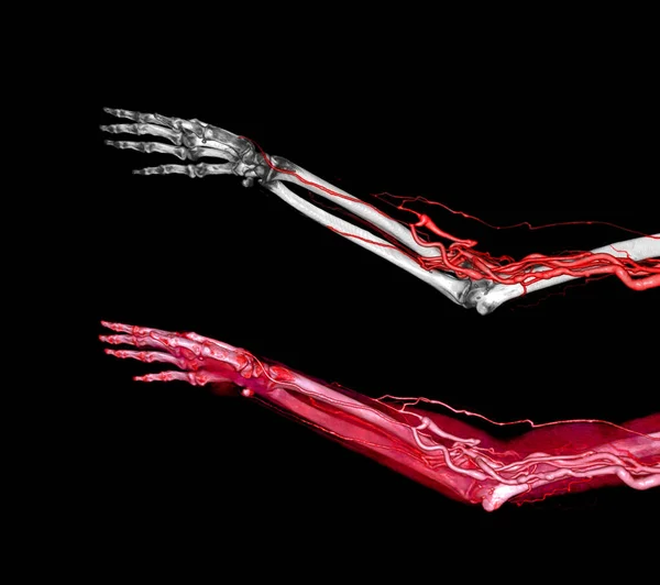 Arterias Braquiales Del Brazo Con Representación Del Hueso Extremidad Superior — Foto de Stock