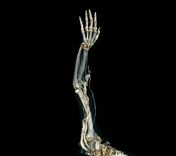 Плечевые Артерии Руки Верхней Конечностью Кость Рендеринг Помощью Сканера — стоковое фото