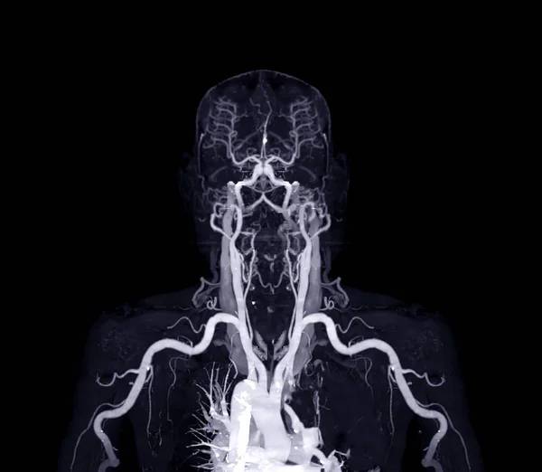 Βραχιαία Αρτηρίες Του Βραχίονα Άνω Άκρο Οστών Απόδοση Από Scanner — Φωτογραφία Αρχείου