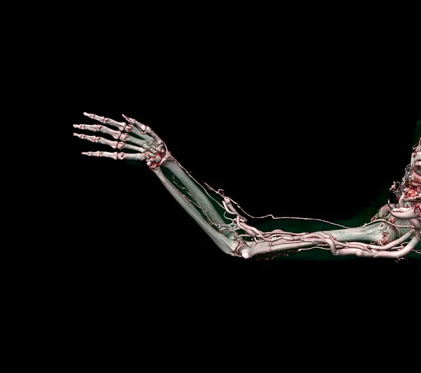 Brachiale Slagaders Van Arm Met Upper Extremity Bone Rendering Van — Stockfoto