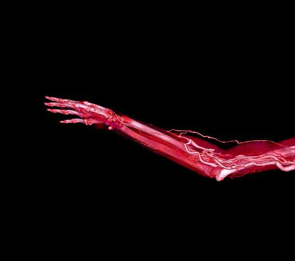 Kolun Üst Ekstremite Arterleri Tomografide Kemiğe Sahip — Stok fotoğraf