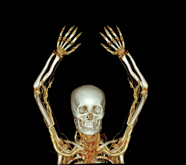 Brachiale Slagaders Van Arm Met Upper Extremity Bone Rendering Van — Stockfoto
