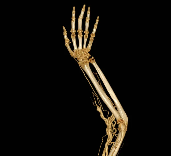 Brachiale Slagaders Van Arm Met Upper Extremity Bone Rendering Van — Stockfoto