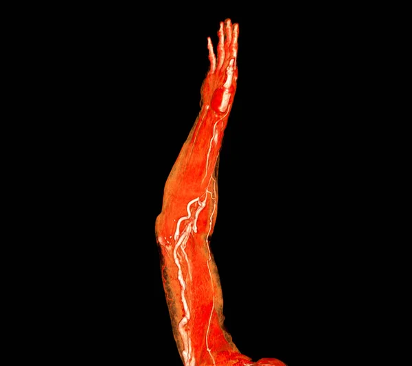 Arterias Braquiales Del Brazo Con Representación Del Hueso Extremidad Superior —  Fotos de Stock