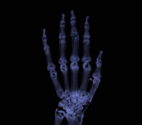 Χέρι Απόδοση Για Ρευματοειδή Αρθρίτιδα Concept — Φωτογραφία Αρχείου
