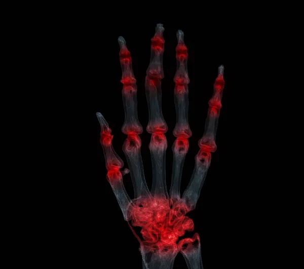 Kézi Renderelés Rheumatoid Arthritis Koncepció — Stock Fotó