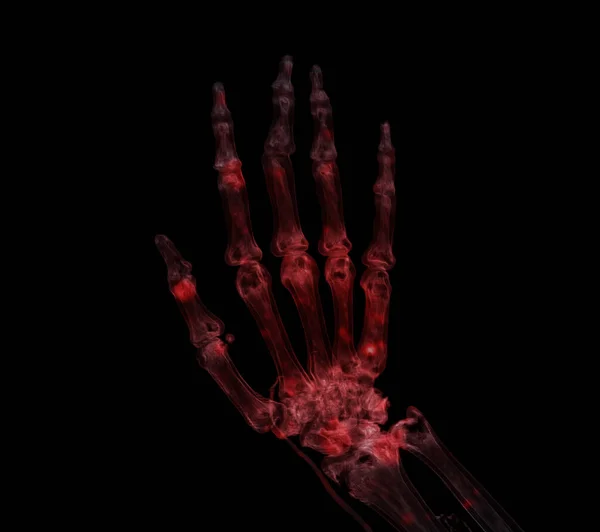 Mão Renderização Para Artrite Reumatoide Conceito — Fotografia de Stock