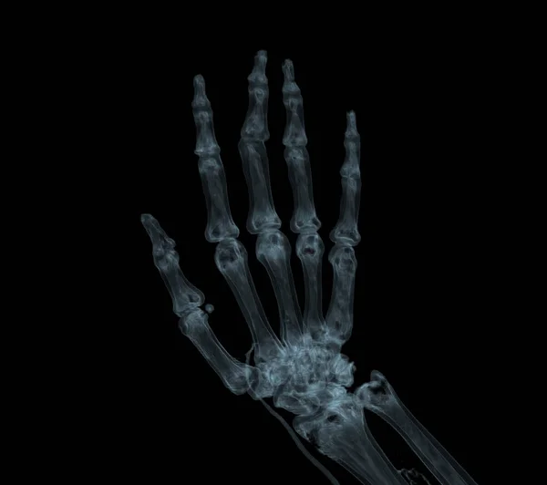 Representación Mano Para Artritis Reumatoide Concepto —  Fotos de Stock