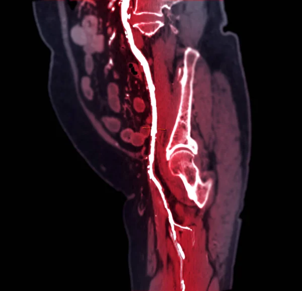 Cta Artéria Femoral Escorrer Imagem Artéria Femoral Para Diagnóstico Doença — Fotografia de Stock