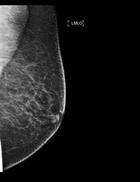 Ray Digital Mammogram Mammography Both Side Breast Showing Benign Tumor — Stock Photo, Image