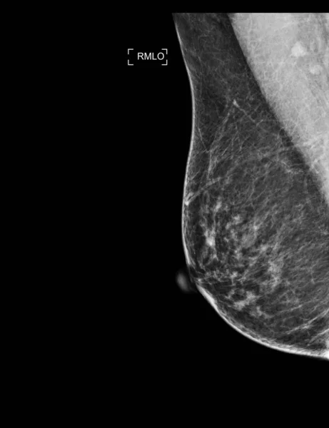 Radiographie Mammographie Numérique Mammographie Des Deux Côtés Montrant Sein Normal — Photo