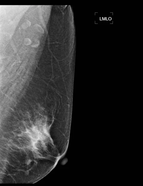 Ray Digital Mammogram Mammography Both Side Breast Showing Benign Tumor — Stock Photo, Image