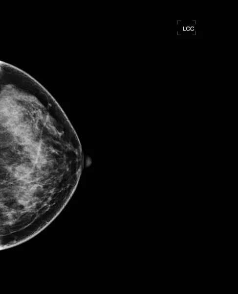 Mammographie Numérique Rayons Mammographie Des Deux Côtés Sein Montrant Une — Photo