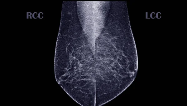 X-ray Digital Mammogram or mammography of both side breast MLO View showing benign tumor BI-RADS 2 should be checked once a year.