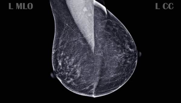 Ray Digital Mammogram Mammography Left Normal Breast Showing Normal Breast — Stock Photo, Image