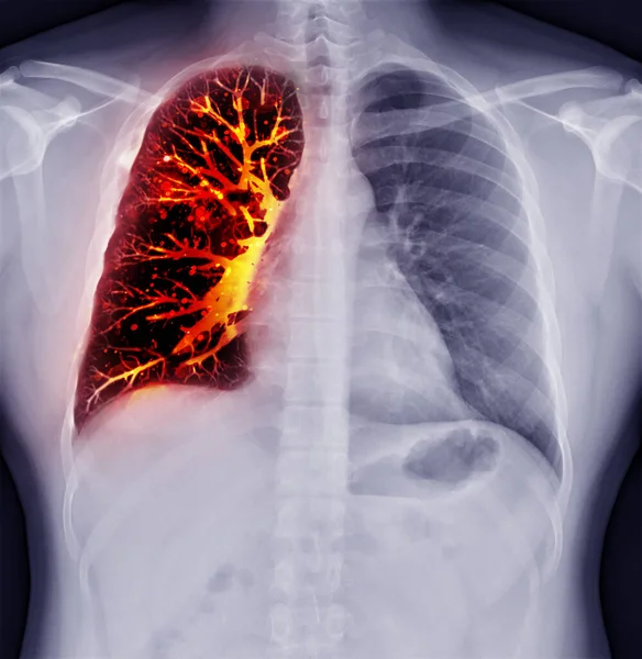Fusion image of Chest x-ray and CT Chest  Coronal view  for lung infection from covid-19 Concept.