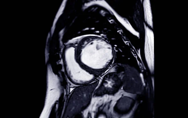 MRI heart or Cardiac MRI in short axis view showing cross-sections of the left and right ventricle for diagnosis heart disease.