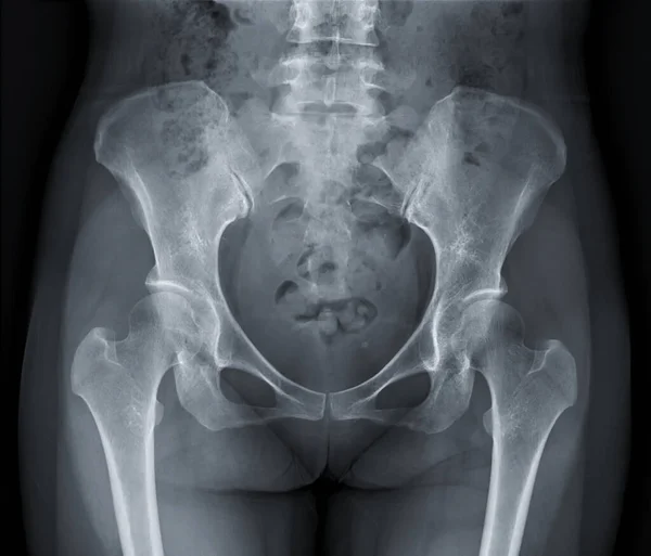 X-ray image of Pelvic bone.