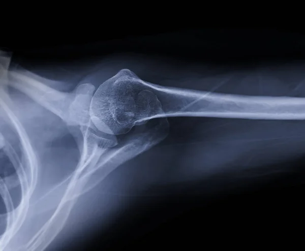 X-ray Shoulder joint shoulder transaxillary view for diagnosis fracture of shoulder joint.