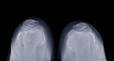 X-ray image of  both patella fracture for diagnostic patella fracture or patella dislocation.