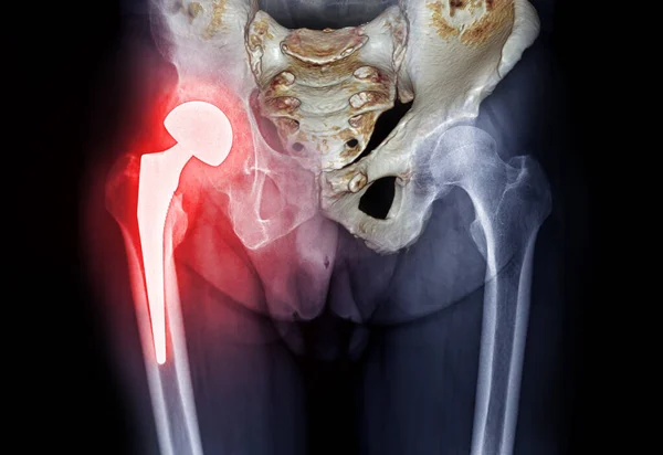 x-ray Both hip  ap view showing Right hip replacement or hip prosthesis made from titanium with fusion 3D rendering .