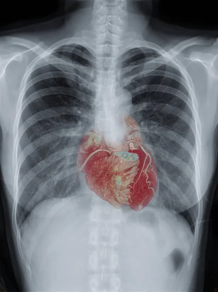 Fusion Image Chest Ray Image Cta Coronary Artery Screening Diagnosis — Stock Photo, Image