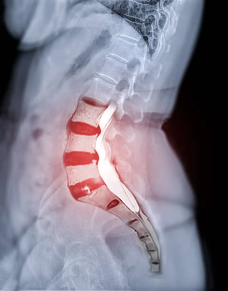 X-ray image of lumbar Spine  or L-s spine lateral view with MRI  l-s spine  for diagnosis lower back pain.