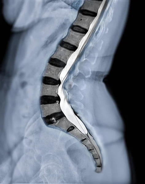 X-ray image of lumbar Spine  or L-s spine lateral view with MRI  l-s spine  for diagnosis lower back pain.