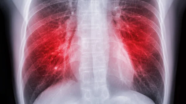 Chest Ray Image Screening Diagnosis Tuberculosis Covid — Stock Photo, Image