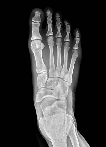 Foot x-ray image AP view  isolated on black background.