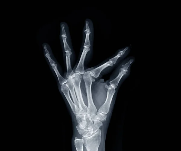 Film x-ray both hand AP view show  human's hands isolated  on black background .