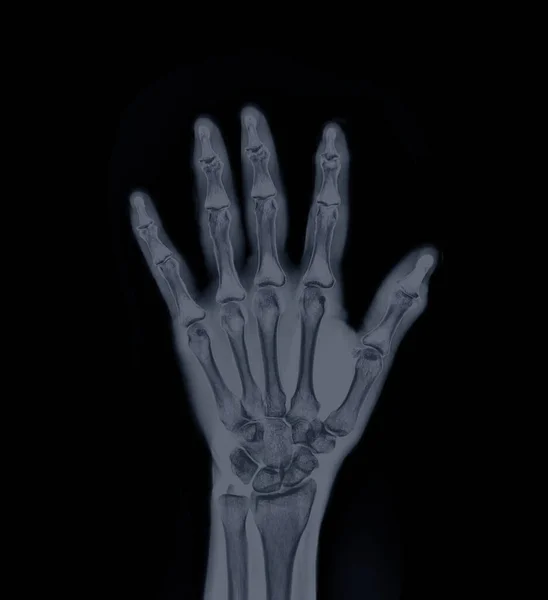 Film x-ray Left  Hand  AP view show  human\'s hands isolated  on black background .