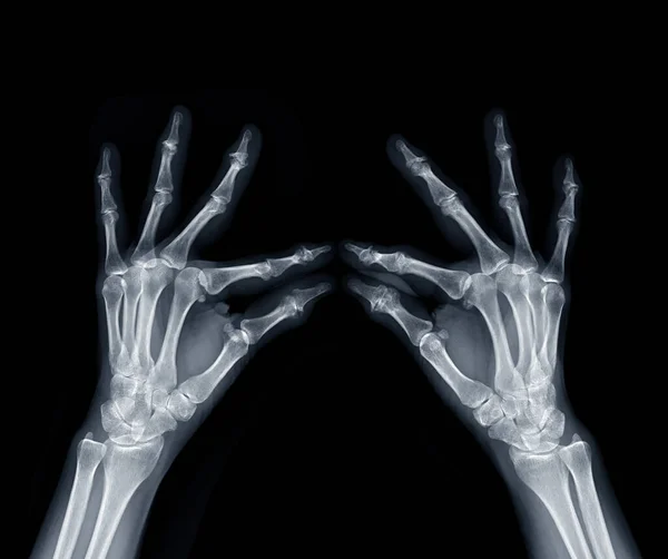 Film x-ray both hand oblique view show  human's hands isolated  on black background .
