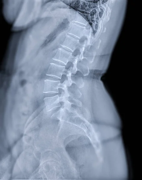 X-ray image of lumbar Spine  or L-s spine lateral view for diagnosis lower back pain.