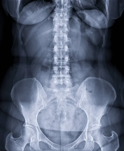 X-ray image of lumbar Spine  or L-s spine front view for diagnosis lower back pain.