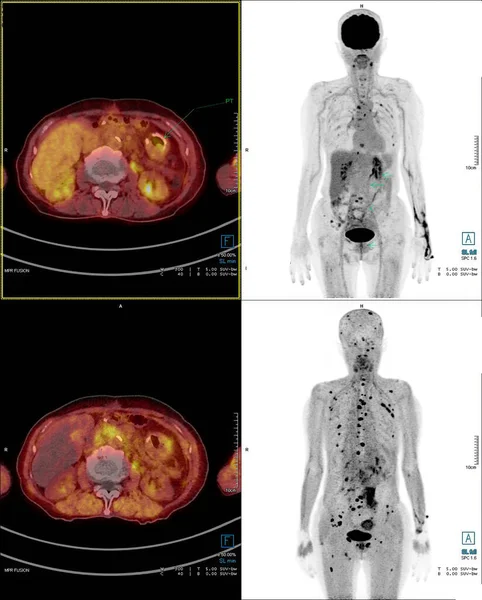 Positron emission tomography (PET) CT scan uses a radioactive drug (tracer) to show both normal and abnormal metabolic activity of Whole  human body  for detect cancer recurrence after surgery .