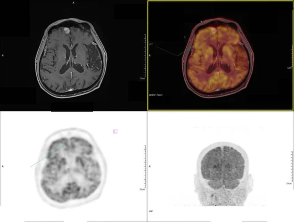 Positron emission tomography (PET) CT scan uses a radioactive drug (tracer) to show both normal and abnormal metabolic activity of Whole  human body  for detect cancer recurrence after surgery .
