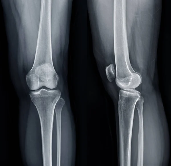 Film x-ray  of Left knee joint  AP and Lateral view  for diagnosis knee pain from osteoarthritis knee  and fracture .