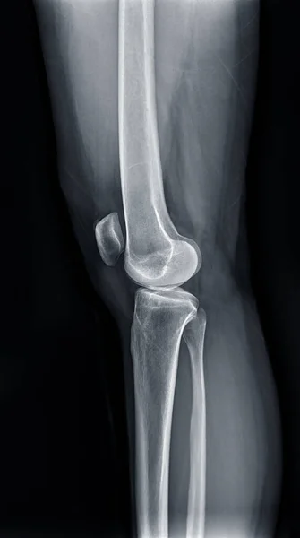 Film x-ray  of Left knee joint  Lateral  view  for diagnosis knee pain from osteoarthritis knee  and fracture .